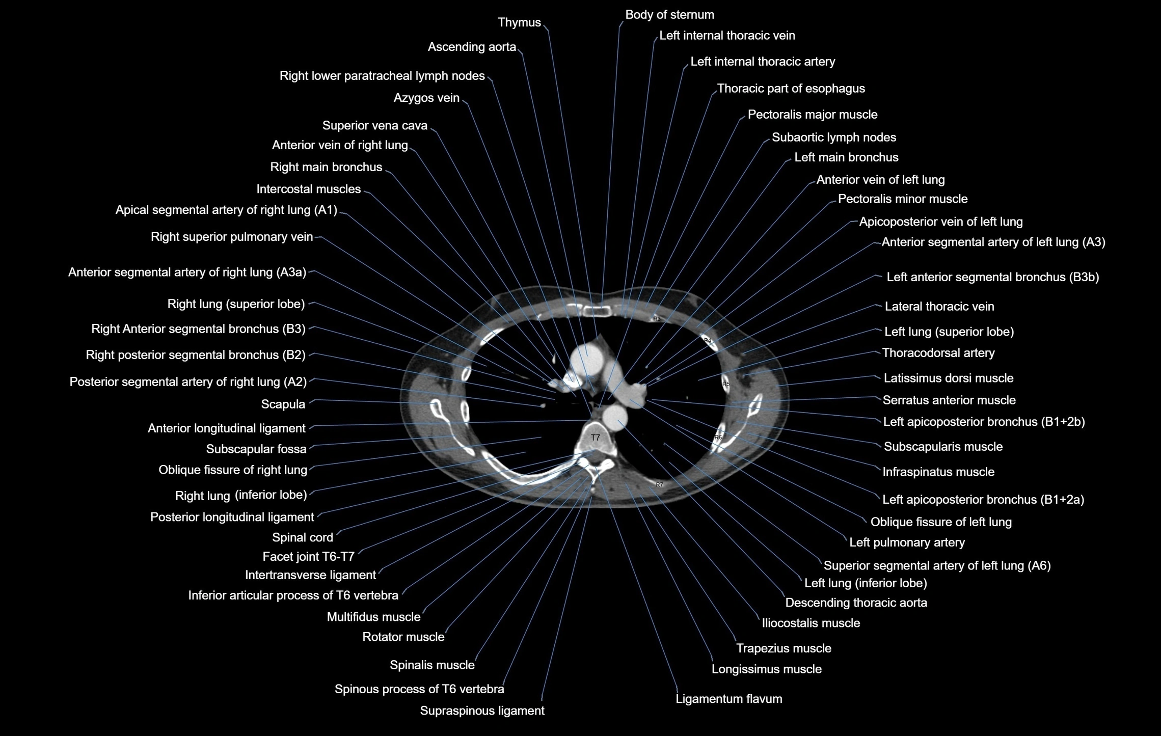 CT chest (thorax) labelled axial cross sectional anatomy radiology image-00050.webp